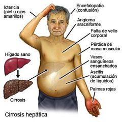 4. Cirrosis Hepatica