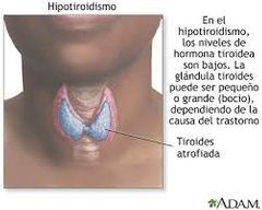 5. Hipotiroidismo