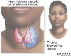6. Hipertiroidismo