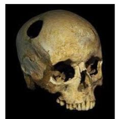 Se observa que el hombre Primitivo realizaba cirugía de cráneo a la enfermedad mental se cree que los agujeros servían para desalojar los espíritus malignos o demonios de las personas afectadas.
