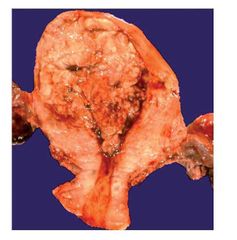 Adenocarcinoma Endometrial