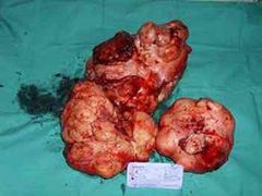 Leiomiosarcoma de útero