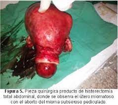 Miomatosis uterina con aborto de un mioma submucoso