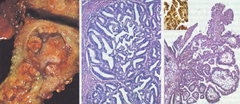 Carcinoma Endometrial tipo 1