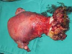 Sarcoma del estroma endometrial