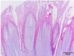 Describe this microscopic image of viral papilloma.