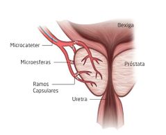 ¿Cual es el origen de las arterias prostáticas?