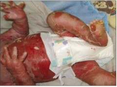 Afecta principalmente a neonatos y niños pequeños, eritema peribucal, exfoliación laminar, Signo de Nikolski positivo, descamación epitelial