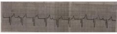 22. Al analizar la tira del ECG diremos que el paciente tiene un ritmo:
a) Activación del marcapasos
b) Taquicardia auricular
c) Bloqueo AV de primer grado
d) Bradicardia sinusal