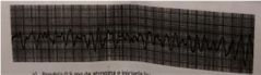 25. Cuál sería la primera actuación ante un paciente con este ritmo:
a) Pondría 0.5 mg de atropina e iniciaría las compresiones
b) Como se trata de una fibrilación ventricular procedería a desfibrilar
c) Como se trata de una fibrilación au...