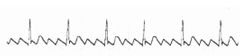 7. Al analizar el ritmo del paciente dada una tira del ECG diremos que:
a) La FC es normal, tiene ritmo sinusal porque presenta onda P, el QRS es estrecho, la distancia PR es normal y las ondas P van seguidas de QRS.
b) La FC es normal, ritmo regu...