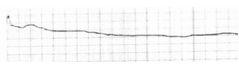 8. Ante el siguiente ritmo cardiaco en el monitor se debería actuar de la siguiente manera:
a) Se trata de una desconexión del aparato y no realizaría ninguna actividad.
b) Cómo se trata de un ritmo caótico procedería a desfibrilar
c) Acerca...