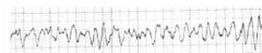 9. Cómo actuarías ante un paciente que se conecta al monitor y aparece este ritmo cardiaco:
a) Pondría 0.5 mg de atropina e iniciaría las compresiones
b) Como se trata de una fibrilación ventricular procedería a desfibrilar
c) Como se trata ...