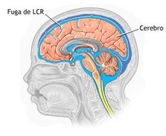 Líquido cefalorraquídeo (LCR)