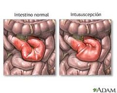 (n phrase) = obstrucción intestinal