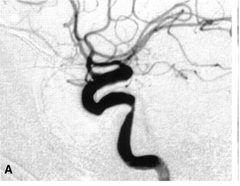 This cerebral angiogram shows a stenosis in which vessel?
