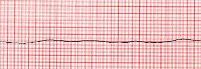 Identify the ECG strip's cardiac rhythm.