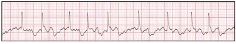 Identify the ECG strip's cardiac rhythm.