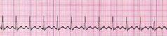 Identify the ECG strip's cardiac rhythm.
