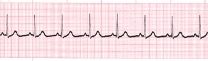 Identify the ECG strip's cardiac rhythm.