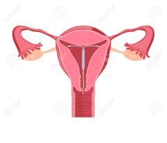 Método anticonceptivo dentro del útero, en forma de ¨T¨ el cual libera iones de cobre que inmovilizan a los espermatozoides.El DIU, una vez colocado dentro de la matriz, puede permanecer en su sitio hasta por 5 ó 10 años