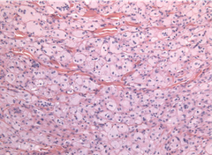 Acúmulos de macrófagos espumosos cargados de lípidos subcutáneos "secundario a hiperlipidemias adquiridas o congénitas"