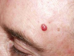 PAPULA
Solida
Sobreelvada
Mide menos de 5 a 10 mm
Presenta cambios secundarios a tipo costra o escama
HISTOLOGIA:
Engrosamiento de la dermis
Acumulo de células o deposito dentro de la dermis.