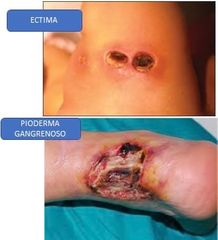 TIPOS DE ULCERAS:
-Estasis
-Pioderma gangrenoso
-Ectima
-Ulcera neuropatica
HISTOLOGIA:
-Destrucción de epidermis, dermis