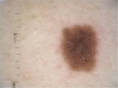 MACULA
-Lesion plana
-Mide hasta 10 mm 
-Colo diferente al de la piel
-Se forma por destrucción de los melanocitos
-Dilatación de los capilares
-Extravasion de eritrocitos