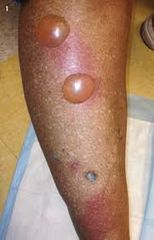 What is this lesion?

What is the differential diagnosis?