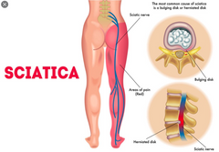 Sciatic means things relating to hipSciatic nerve. ... It is the longest and widest nerve in the human body. The sciatic nerve primarily supplies the muscles of the lower leg. It also supplies sensation to the sole of the foot, the ankle, the enti...