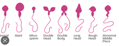 Tetratozoospermija- ejakulātā ir liels daudzums nepareizu spermatozoīdu
Azoospermija- ejakulātā nav spermatozoīdu
Oligoospermija- zems spermatozoīdu skaits (< 20 milj. 1ml ejakulāta
Tikai sertoli šūnu sindroms- izlocītajā kanālā ir t...