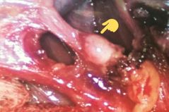 Ganglio linfático centinela de la vesícula biliar,  estadificador del cáncer. Se ubica en el borde interno del inicio del conducto cístico.