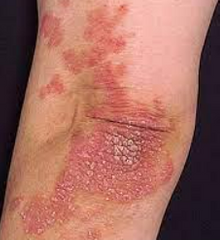 Lesión secundaria: 
Es el aumento del espesor, pigmentación y cuadriculado normal de la piel. (Callosidades)
- Acantosis nigricans
