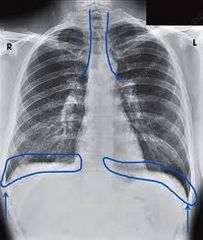 der Reserveraum (Recessus
costodiaphragmaticus)