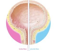 Blasenentzündung