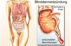 Blinddarmentzündung