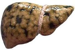 Steatosis hepatis