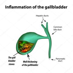 Cholezystitis