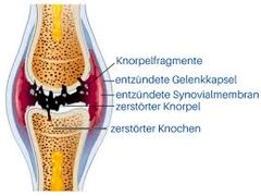 Gelenkverschleiß