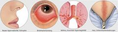 allergische Rhinitis