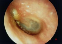 Otitis media