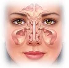 Sinusitis