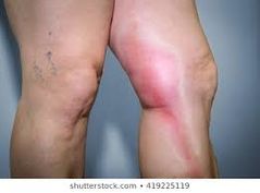 Thrombophlebitis