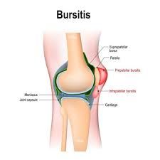 Bursitis