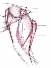 Leveä pitkula lihas M. biceps femorin alla, näkyi välissä