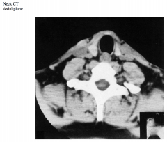 This CT is at the level of the T1 vertebra and includes the inferior parts of the lobes of the thyroid gland.


 


Identify the airway and the structure posterior to it.




Identify the right and left lobes of the thyroid gland.




W...