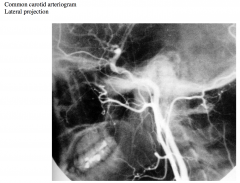 Distinguish the external and internal carotid arteries.


 


What clue did you use to distinguish one from the other?


 


Some of the branches of the external carotid artery can be seen.


 


The occipital, facial and lingual ar...