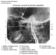 The external carotid artery can be distinguished from the internal carotid artery because the internal carotid artery has no branches in the neck. 