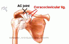 A SHOULDER separation is a dislocation of the acromioclavicular joint T, w/ a rupture of the coracoclavicular LIGAMENT.